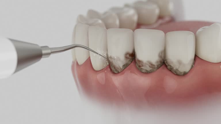 Trusted Wisdom Tooth Removal service in Jersey City, NJ - Dentist Open Now